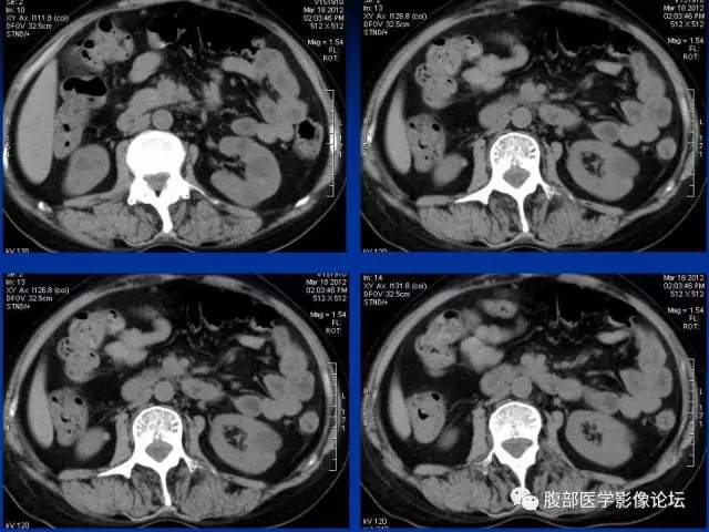 【病例】回肠淋巴瘤并肠套叠1例CT影像表现 【病例】回肠淋巴瘤并肠套叠1例CT影像表现