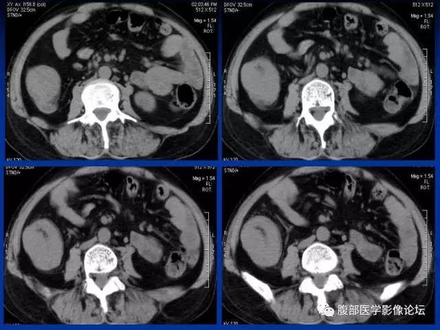 【病例】回肠淋巴瘤并肠套叠1例CT影像表现 【病例】回肠淋巴瘤并肠套叠1例CT影像表现
