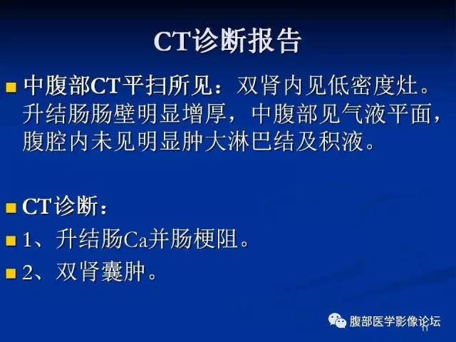 【病例】回肠淋巴瘤并肠套叠1例CT影像表现 【病例】回肠淋巴瘤并肠套叠1例CT影像表现