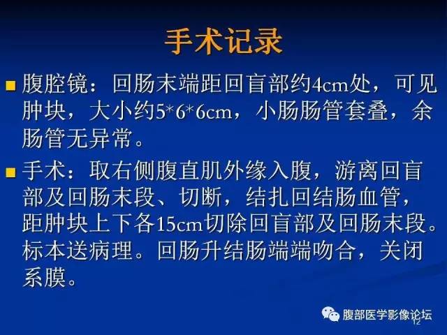 【病例】回肠淋巴瘤并肠套叠1例CT影像表现 【病例】回肠淋巴瘤并肠套叠1例CT影像表现
