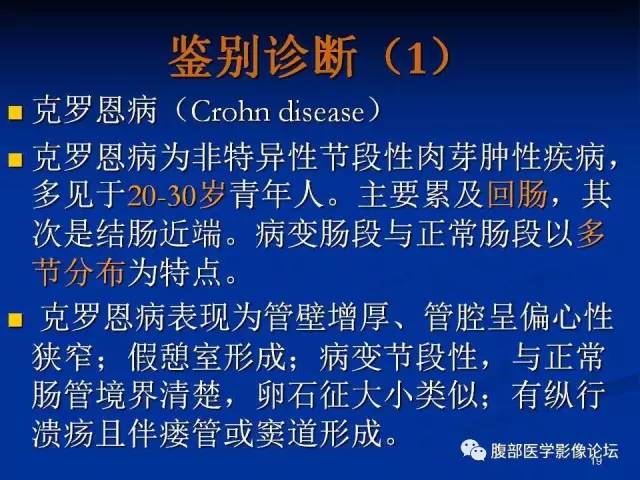 【病例】回肠淋巴瘤并肠套叠1例CT影像表现 【病例】回肠淋巴瘤并肠套叠1例CT影像表现