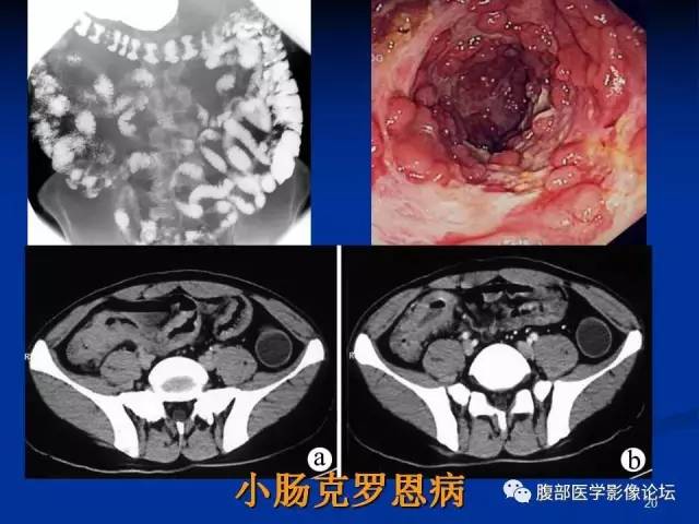 【病例】回肠淋巴瘤并肠套叠1例CT影像表现 【病例】回肠淋巴瘤并肠套叠1例CT影像表现