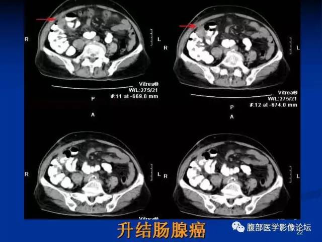 【病例】回肠淋巴瘤并肠套叠1例CT影像表现 【病例】回肠淋巴瘤并肠套叠1例CT影像表现