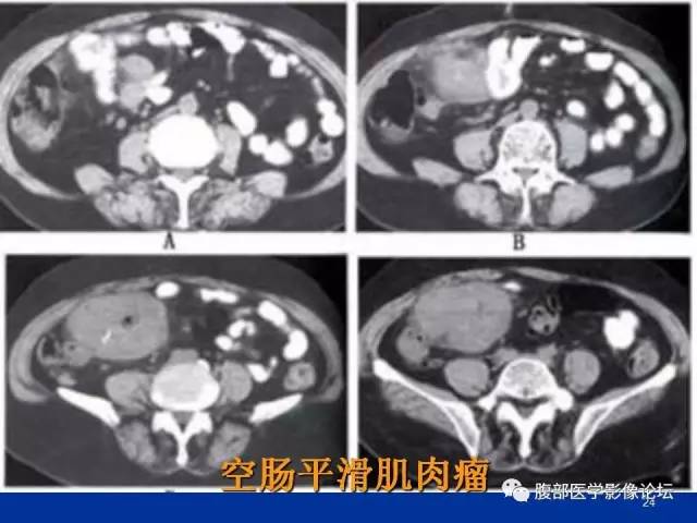 【病例】回肠淋巴瘤并肠套叠1例CT影像表现 【病例】回肠淋巴瘤并肠套叠1例CT影像表现