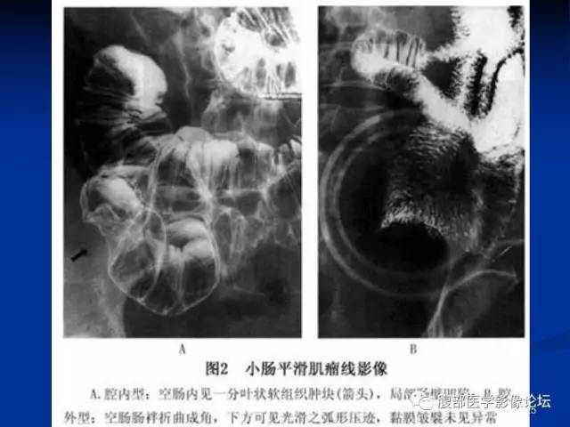 【病例】回肠淋巴瘤并肠套叠1例CT影像表现 【病例】回肠淋巴瘤并肠套叠1例CT影像表现