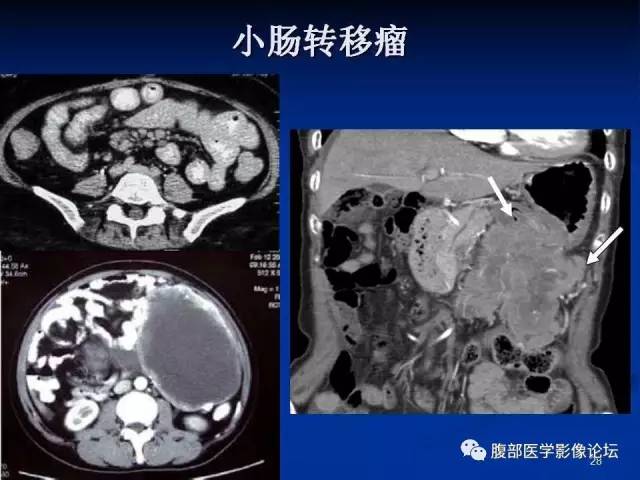 【病例】回肠淋巴瘤并肠套叠1例CT影像表现 【病例】回肠淋巴瘤并肠套叠1例CT影像表现
