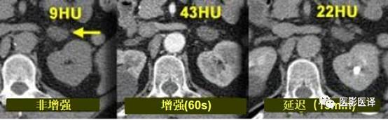 肾上腺良恶性病变的影像学鉴别诊断 肾上腺良恶性病变的影像学鉴别诊断