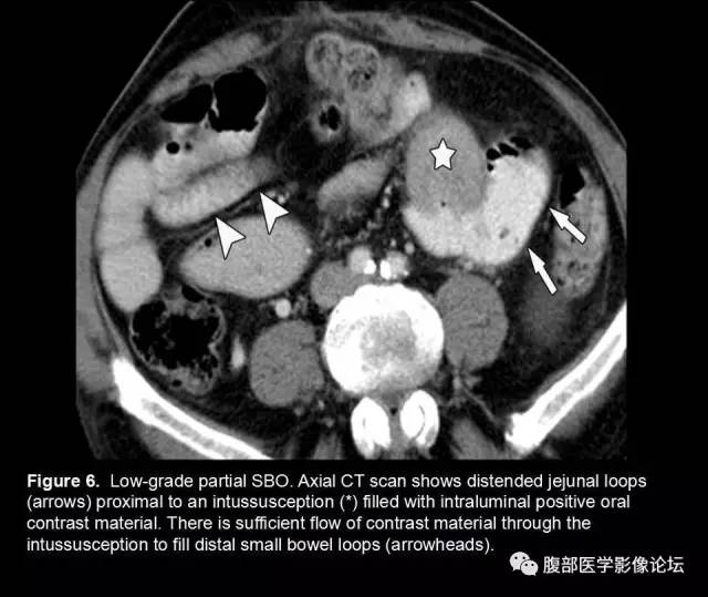 【PPT】小肠梗阻看什么？
