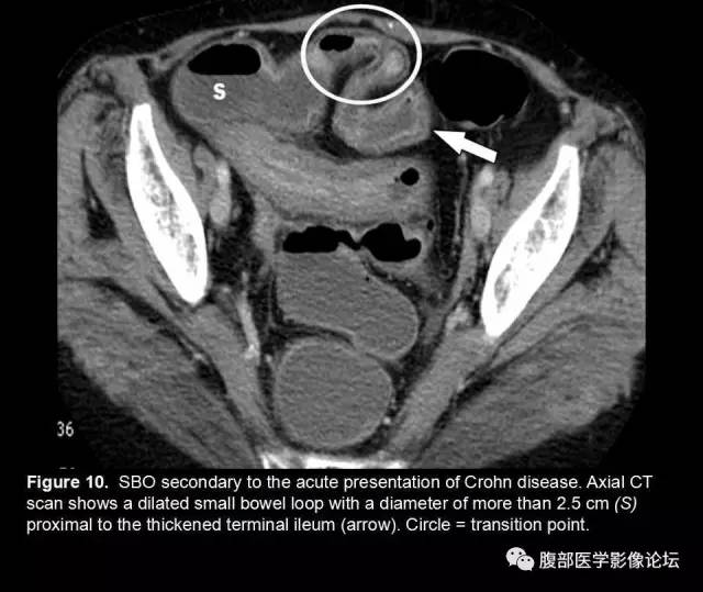 【PPT】小肠梗阻看什么？