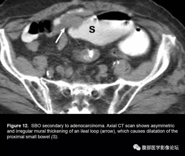【PPT】小肠梗阻看什么？