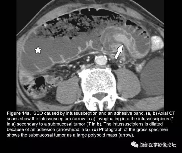 【PPT】小肠梗阻看什么？
