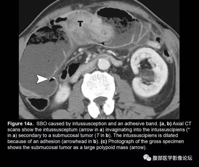 【PPT】小肠梗阻看什么？