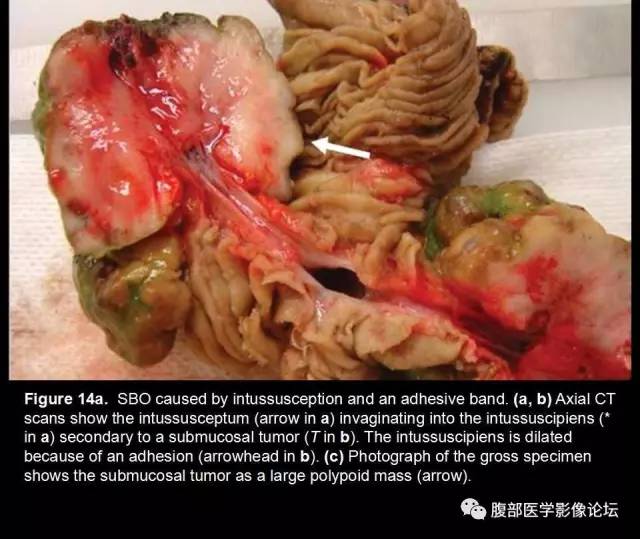 【PPT】小肠梗阻看什么？