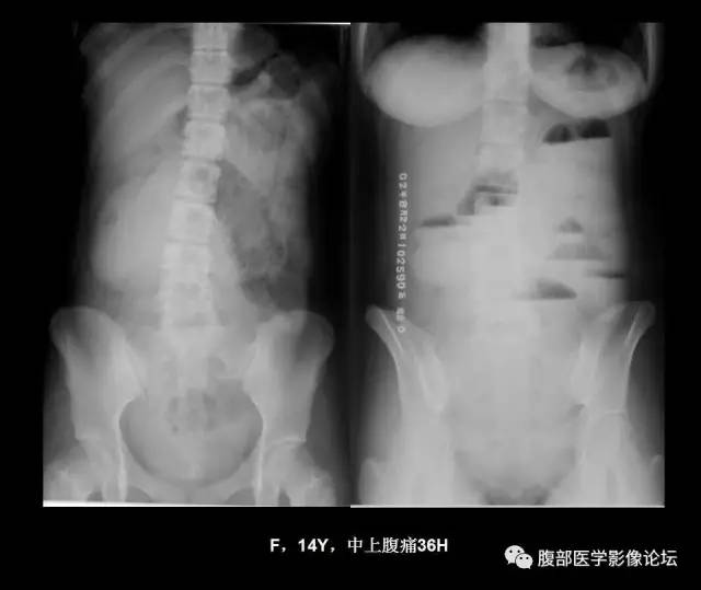 【PPT】小肠梗阻看什么？