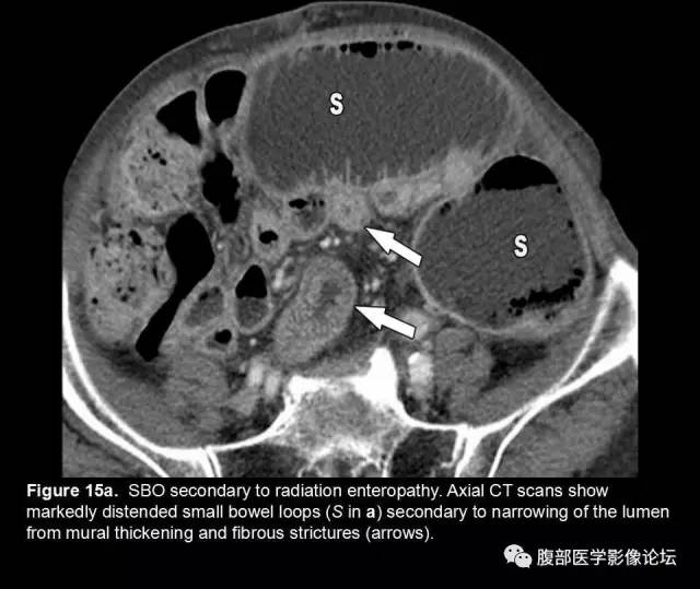 【PPT】小肠梗阻看什么？