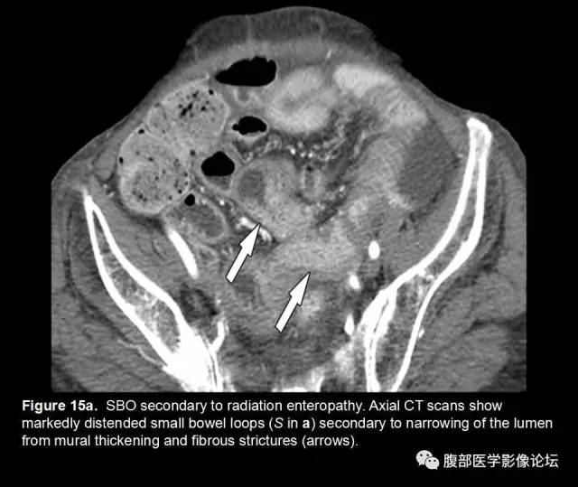【PPT】小肠梗阻看什么？