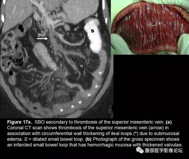 【PPT】小肠梗阻看什么？
