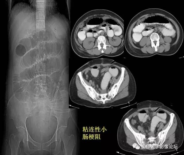 【PPT】小肠梗阻看什么？