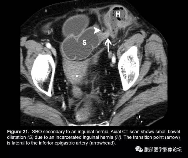 【PPT】小肠梗阻看什么？
