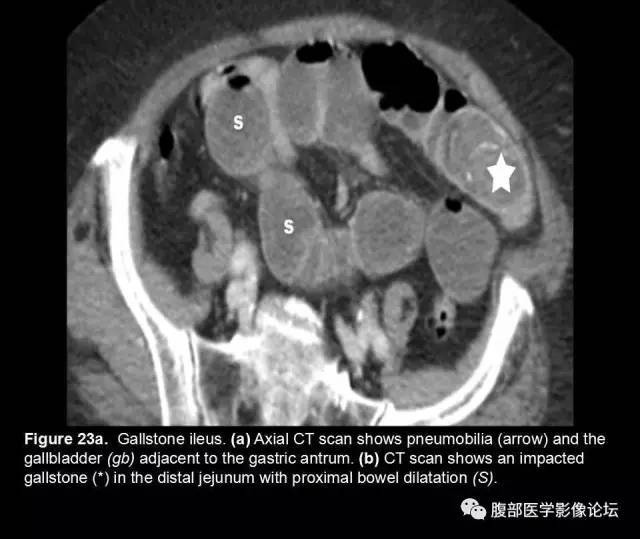 【PPT】小肠梗阻看什么？