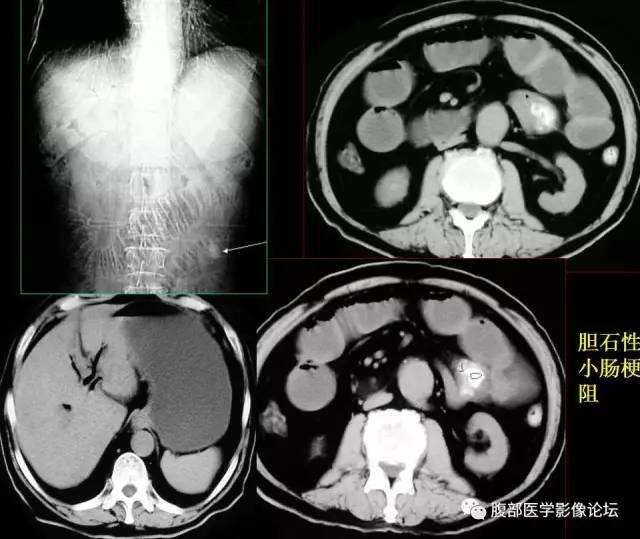 【PPT】小肠梗阻看什么？