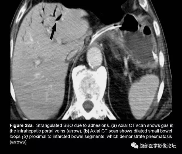 【PPT】小肠梗阻看什么？