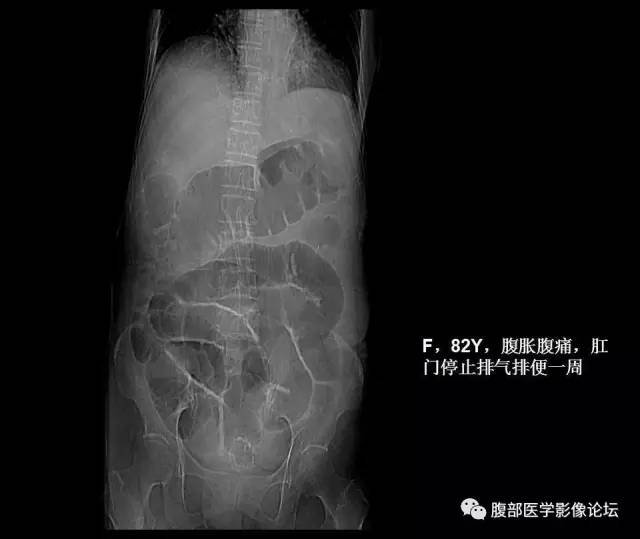 【PPT】小肠梗阻看什么？