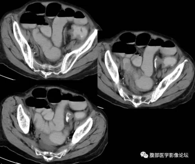 【PPT】小肠梗阻看什么？