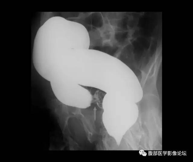 【PPT】小肠梗阻看什么？