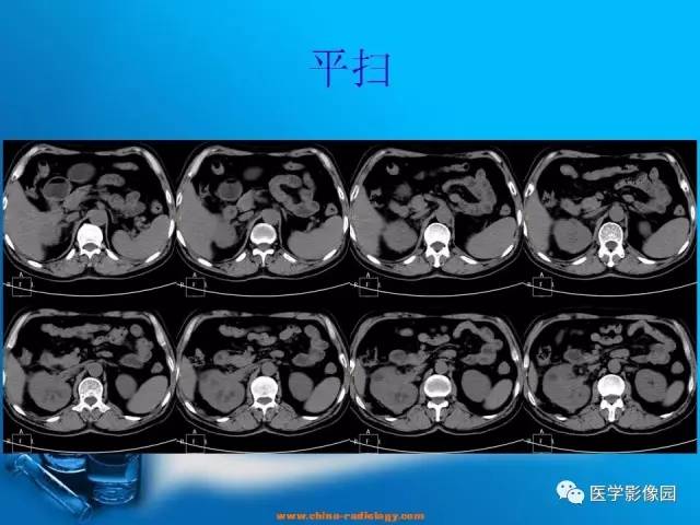 【病例】肾盂癌1例CT影像表现 【病例】肾盂癌1例CT影像表现