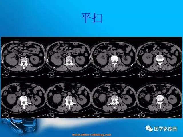 【病例】肾盂癌1例CT影像表现 【病例】肾盂癌1例CT影像表现