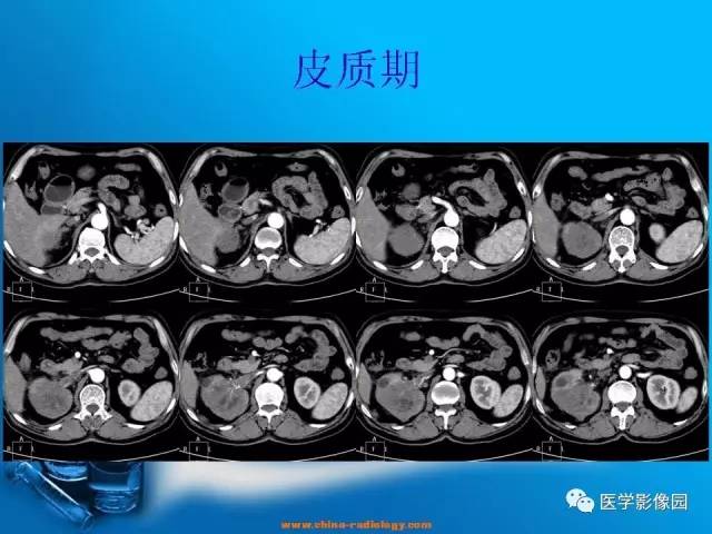 【病例】肾盂癌1例CT影像表现 【病例】肾盂癌1例CT影像表现