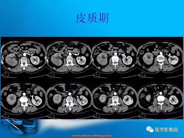 【病例】肾盂癌1例CT影像表现 【病例】肾盂癌1例CT影像表现