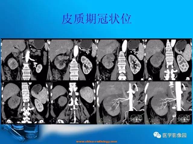 【病例】肾盂癌1例CT影像表现 【病例】肾盂癌1例CT影像表现