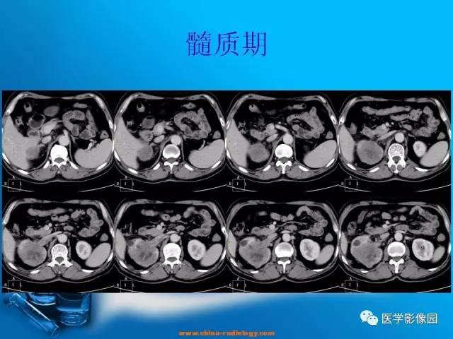 【病例】肾盂癌1例CT影像表现 【病例】肾盂癌1例CT影像表现
