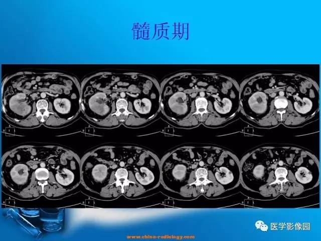 【病例】肾盂癌1例CT影像表现 【病例】肾盂癌1例CT影像表现