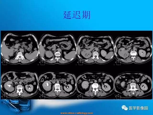 【病例】肾盂癌1例CT影像表现 【病例】肾盂癌1例CT影像表现