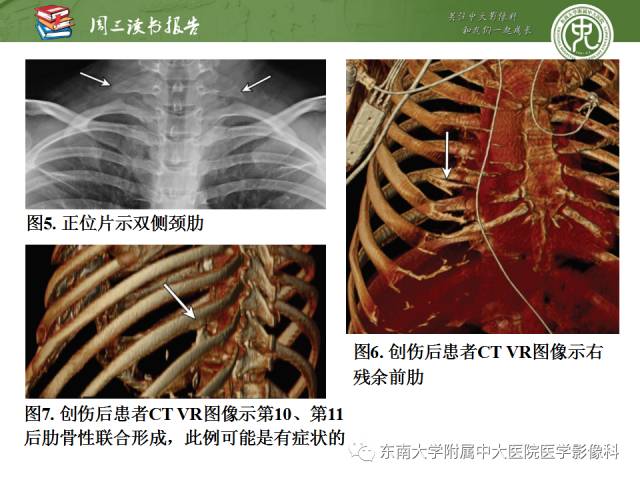 【PPT】创伤性肋骨损伤：类型、影像不足、并发症和治疗【RG精选】