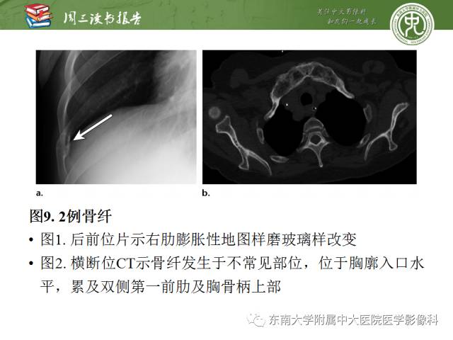 【PPT】创伤性肋骨损伤：类型、影像不足、并发症和治疗【RG精选】