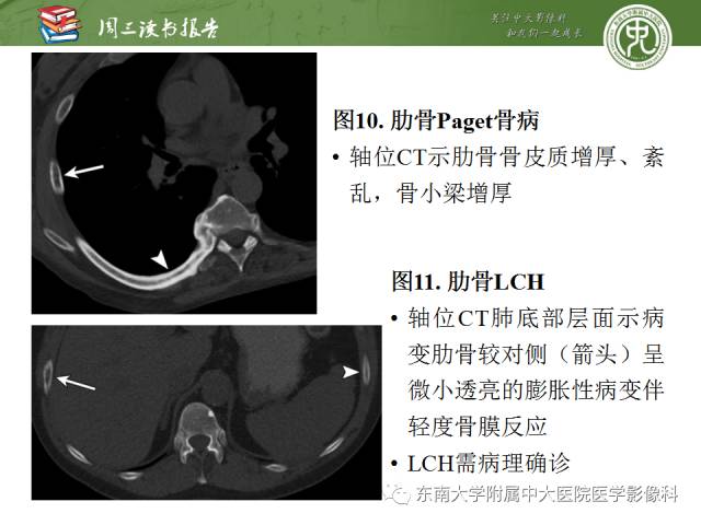 【PPT】创伤性肋骨损伤：类型、影像不足、并发症和治疗【RG精选】