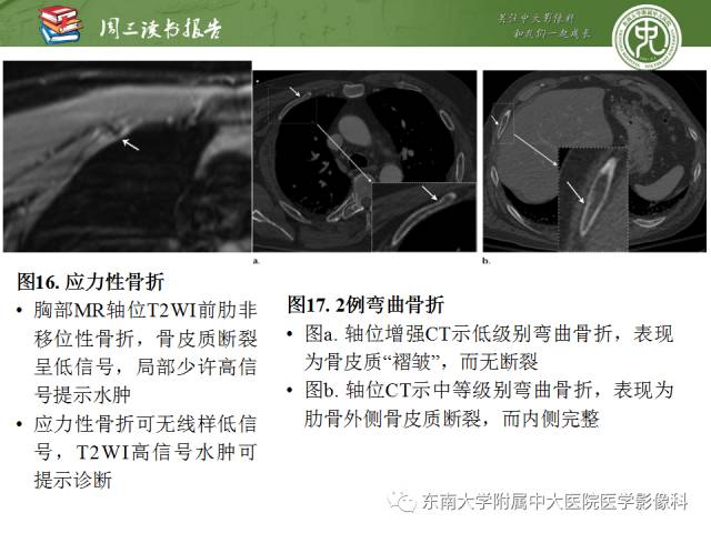 【PPT】创伤性肋骨损伤：类型、影像不足、并发症和治疗【RG精选】