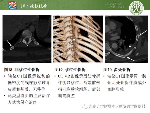【PPT】创伤性肋骨损伤：类型、影像不足、并发症和治疗【RG精选】