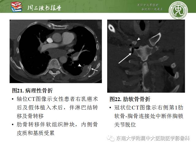 【PPT】创伤性肋骨损伤：类型、影像不足、并发症和治疗【RG精选】