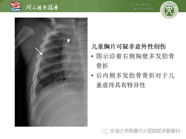 【PPT】创伤性肋骨损伤：类型、影像不足、并发症和治疗【RG精选】