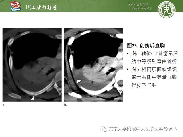 【PPT】创伤性肋骨损伤：类型、影像不足、并发症和治疗【RG精选】