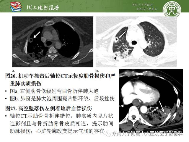 【PPT】创伤性肋骨损伤：类型、影像不足、并发症和治疗【RG精选】