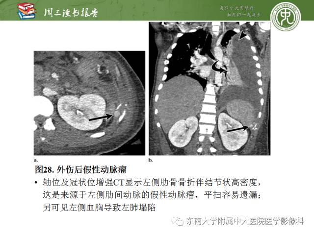 【PPT】创伤性肋骨损伤：类型、影像不足、并发症和治疗【RG精选】
