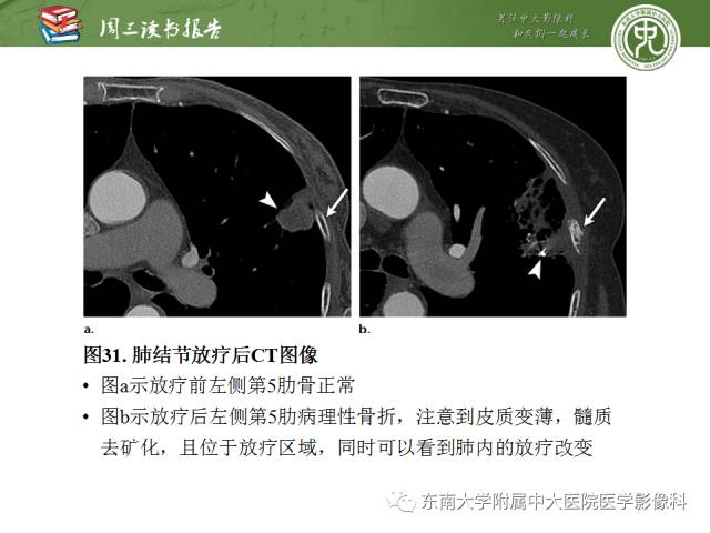 【PPT】创伤性肋骨损伤：类型、影像不足、并发症和治疗【RG精选】
