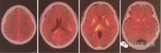 【病例】这例中枢神经系统淋巴瘤不典型,怎么办? 【病例】这例中枢神经系统淋巴瘤不典型,怎么办?