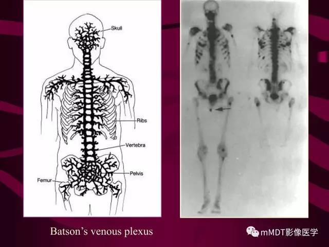 【PPT】骨转移瘤的少见表现
